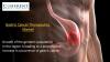 Photo for Gastric Cancer Therapeutics Market – Global Industry Insights and Opportunity Analysis, 2016–2024