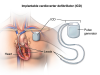 Photo for Implantable Cardioverter-defibrillators Market - Industry Analysis, Size, Share, Growth, Trends and Forecast to 2024