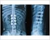 Photo for Global Bone Growth Stimulator Market Research Report 2017