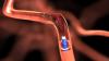 Photo for Global Mechanical Thrombectomy Devices Market Research Report 2017