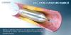 Photo for Global Balloon Catheters Market to Surpass US$ 5.5 Billion