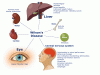 Photo for Wilson’s Disease Treatment Market – Trends, 2017–2025