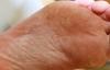 Photo for The Global Tinea Pedis Treatment Market| Fact and Forecast | Growth Factors | Key Trends