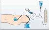 Photo for Intra-Abdominal Pressure Measurement Devices Market Size is Set to Grow at a Remarkable Pace in the Coming Years