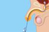 Photo for Global Urinary Self-Catheter Market Future Outlook