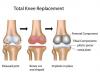 Photo for Knee Implants Market – Global Industry Insights, Trends, Size, Share and Opportunity Analysis, 2017–2025