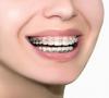 Photo for Global Dental Brackets Industry Market Scope and Revenue Outlook for 2017 - 2022