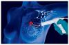 Photo for Breast Cancer Therapeutics Market - Trends  2016–2024