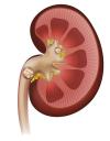 Photo for Global Kidney Stones Market Top Industry Key Players 2022