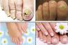 Photo for Toenail Fungus Cure and Preventions
