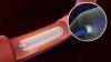 Photo for Drug Eluting Stents Market to Surpass US$ 5.9 Billion Level by 2025