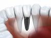 Photo for Try All on 4 Dental Implants San Diego to Beautify Your Smile