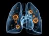 Photo for Non-Small Cell Lung Cancer Market – Global Industry Insights, Trends, Outlook, and Analysis, 2016–2024