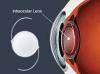 Photo for Intraocular Lens Market Size , Share and Forecast till 2025