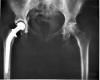 Photo for Extremity Reconstruction Devices Market Size Is Projected To Be Around $4 Billion By 2025