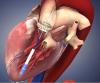 Photo for Cardiovascular Stents Market —  Trends, 2025