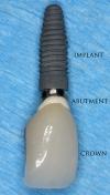 Photo for Dental Implants and Prosthetics Market Is Projected To $16 Billion By 2025