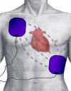 Photo for Automated External Defibrillators Market - Global Industry Analysis and Forecast To 2025