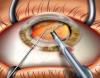 Photo for Ocular Surgery Market to Surge Past US$ 2.6 Billion by 2025 Due to Growing Aging Population
