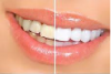 Photo for Teeth Whitening Products Market Size Worth USD 7.40 Billion By 2024
