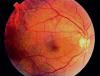 Photo for Diabetic Retinopathy Market Analysis by Type, Management Forecast To 2025