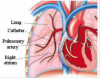 Photo for Pulmonary Artery Catheters Market —  Trends  and Opportunity Analysis 2025