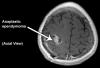 Photo for H2 2017 Ependymoma Industry Pipeline Review Size, Share, Trend and Analysis Research Study