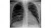 Photo for H2 2017 Pseudomonas Aeruginosa Pneumonia Market Pipeline Review Industry Research Report