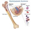 Photo for Global Myelodysplastic Syndrome Treatment Market to US $ 5.7 bn 2025
