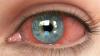 Photo for Uveitis Treatment Market By Indication, Cause, Condition, and Drug – Global Industry Insights, Trends, Outlook, and Opportunity Analysis, 2017-2025