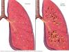 Photo for Cystic Fibrosis Market –  Trends 2016–2024