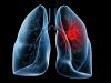 Photo for Non-Small Cell Lung Cancer Market –  Trends, Outlook 2024