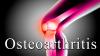 Photo for Osteoarthritis Treatment Market - Global Industry Insights, Trends, Outlook, and Analysis, 2017–2025