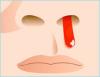 Photo for Global Epistaxis Market is expected to expand at a CAGR of 5.7% in 2025