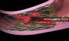 Photo for Bioabsorbable Stents Market - Global Industry Insights, Trends, and Opportunity Analysis, 2017-2025