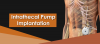Photo for Intrathecal Pumps Market-Trends, Outlook, and Opportunity Analysis, 2017-2025