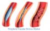 Photo for Peripheral Vascular Devices Market – Global Industry Insights, Trends, Outlook, and Analysis, 2017–2025