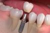 Photo for Now get the strongest implants for your lost teeth in Clifton NJ