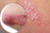 Photo for Psoriasis Treatment in Pune | Ayurvedic Clinic In Pune