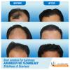 Photo for MEN HAIR TRANSPLANT