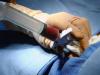 Photo for Bone Marrow Transplant Sales Market Shows Speedy Growth