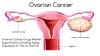Photo for Ovarian Cancer Drugs Market - Global Industry Insights, Trends, Outlook, and Analysis, 2016-2024