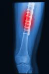 Photo for Orthopedic Trauma Devices Market –  Trends, 2016–2024