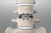 Photo for Cervical Total Disc Replacement Device Market Trends Will double by 2024