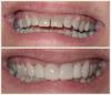 Photo for Dental Implants