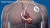 Photo for Implantable drug delivery devices – Bid good bye to painful needles