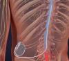 Photo for Active Implantable Medical Devices Market-Global Forecast to 2025