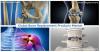 Photo for Bone Replacement Products Market to Generate Revenue of US$ 46.6 Billion by 2025