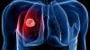 Photo for Non-Small Cell Lung Cancer Market – Outlook Trends, 2024