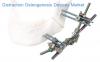 Photo for Distraction Osteogenesis Devices Market - Global Industry Insights, Trends, Outlook, and  Analysis, 2017-2025